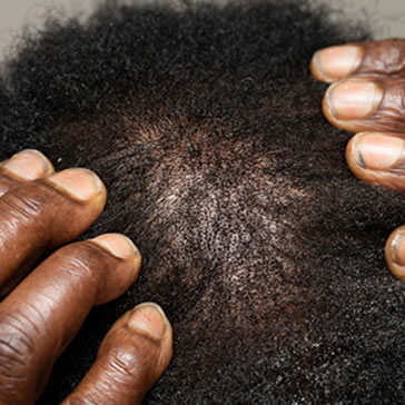 scalp